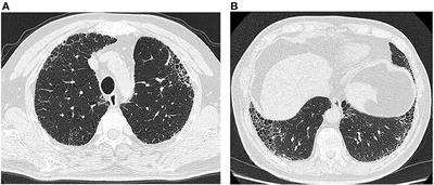 Microscopic polyangiitis initially presenting with idiopathic pulmonary fibrosis: a case report